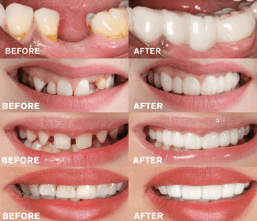 facetas-odontologicas-removiveis-smileveneers-loja-sters-mey-2 - Loja STÉRS.Mey