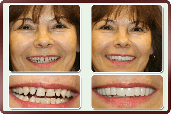 facetas-odontologicas-removiveis-smileveneers-loja-sters-mey-4 - Loja STÉRS.Mey