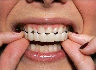 facetas-odontologicas-removiveis-smileveneers-loja-sters-mey-6 - Loja STÉRS.Mey